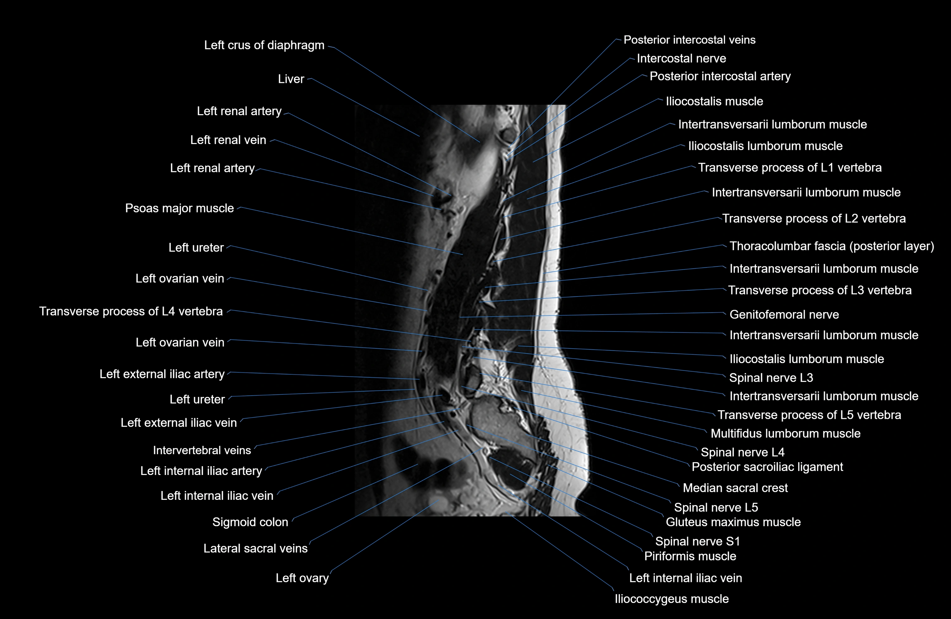 MRI lumbar spine sagittal cross sectional anatomy 3T radiology  image-img-00001-00024.webp